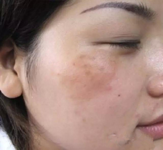 眼角下的老年斑