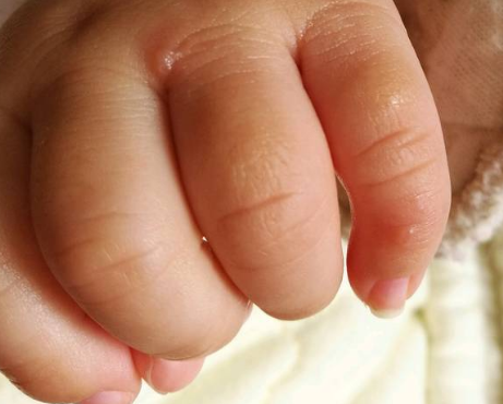 寶寶手上長水泡