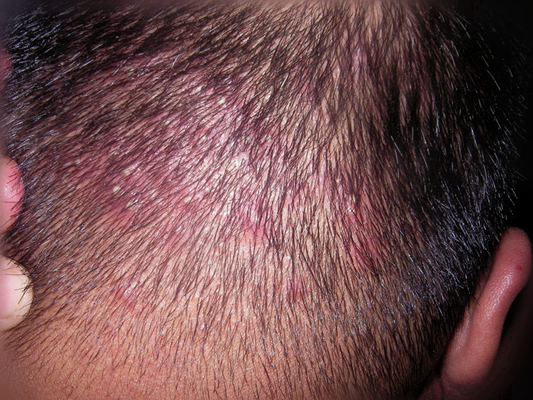頭皮脂溢性皮炎 (33) 