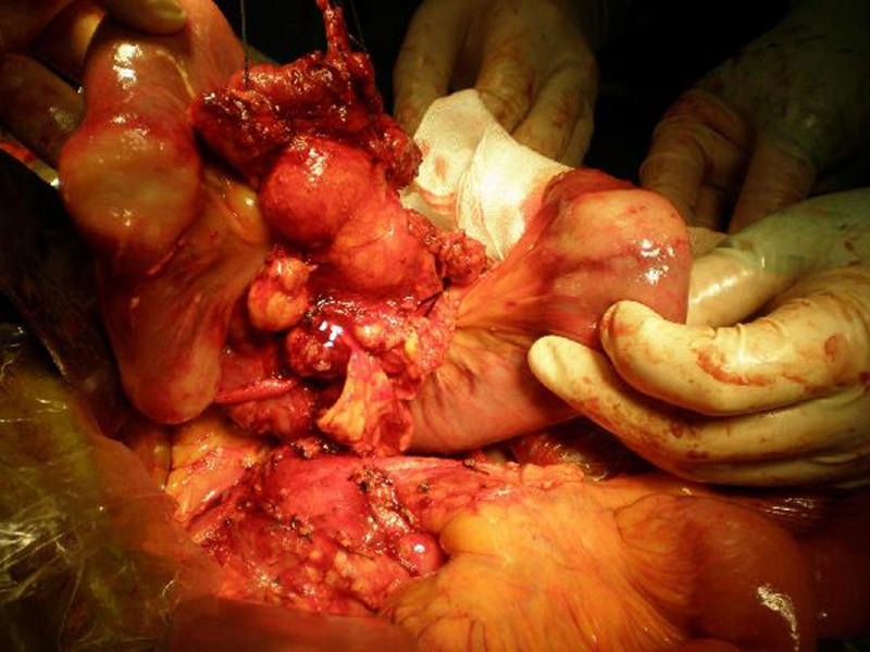 直腸腫瘤的報告單