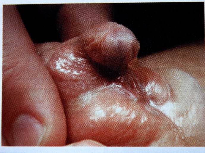 男性假兩性畸形陰莖