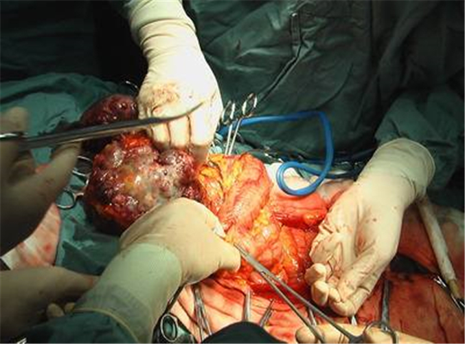 卵巢癌晚期手術