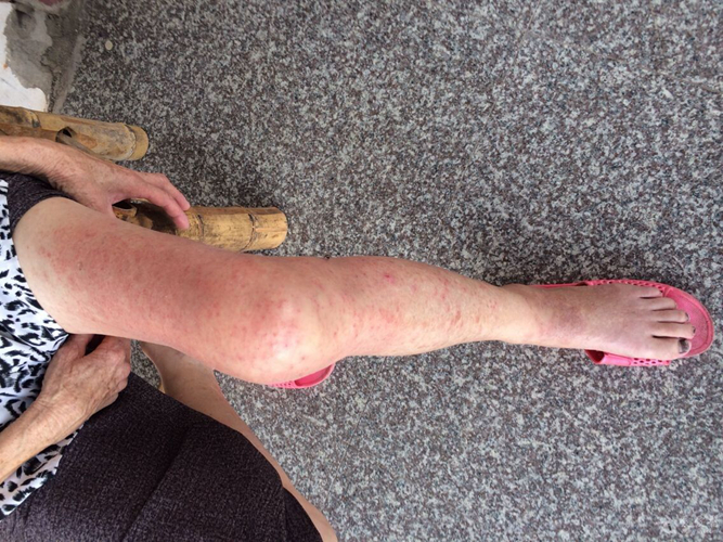 腿部接觸性皮炎