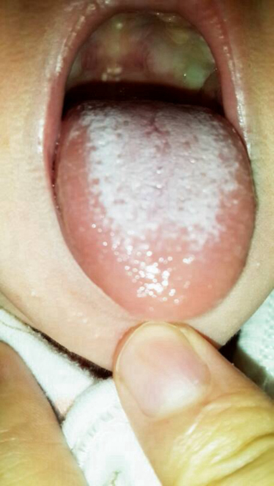 寶寶鵝口瘡 (74) 