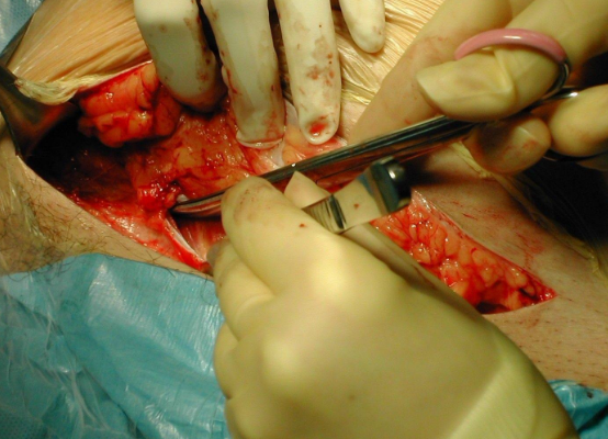 剖腹產手術 (57) 