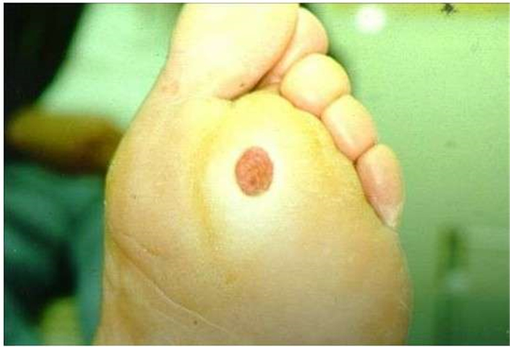 早期糖尿病足症狀