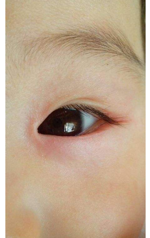 眼睛麥粒腫初期