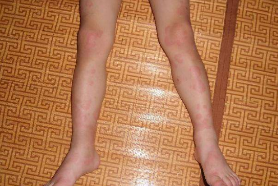 身體蟎蟲過敏症狀