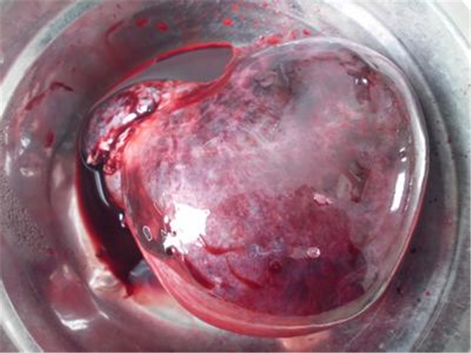 切除的卵巢囊腫什麼樣