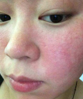 臉上皮膚過敏症狀