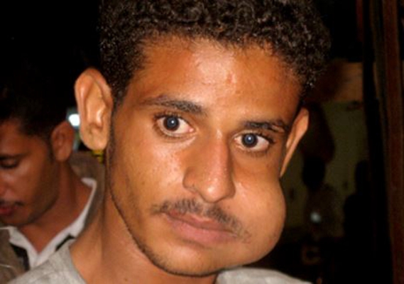 腮腺炎的症狀和