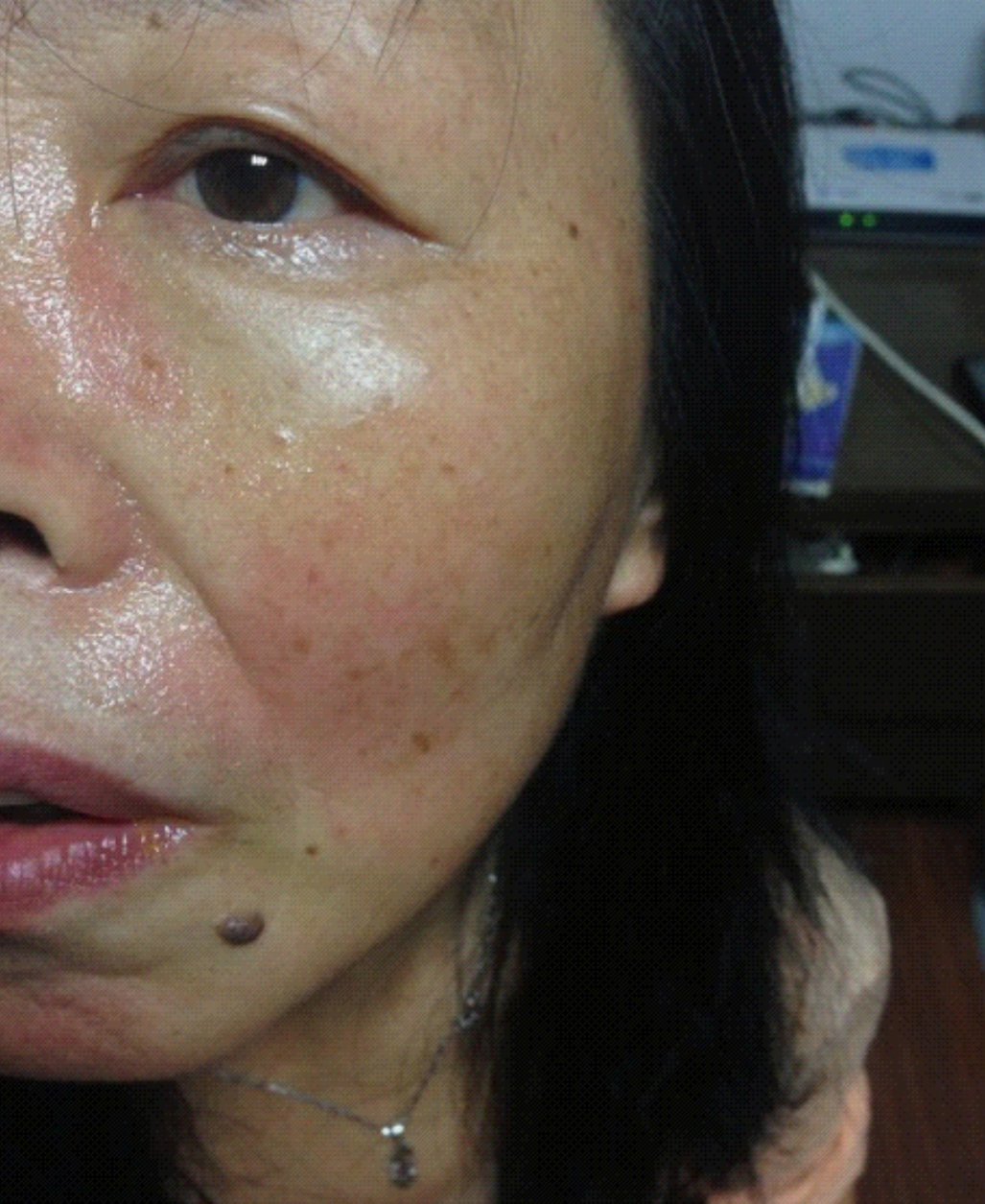 臉上皮囊炎怎麼治療 