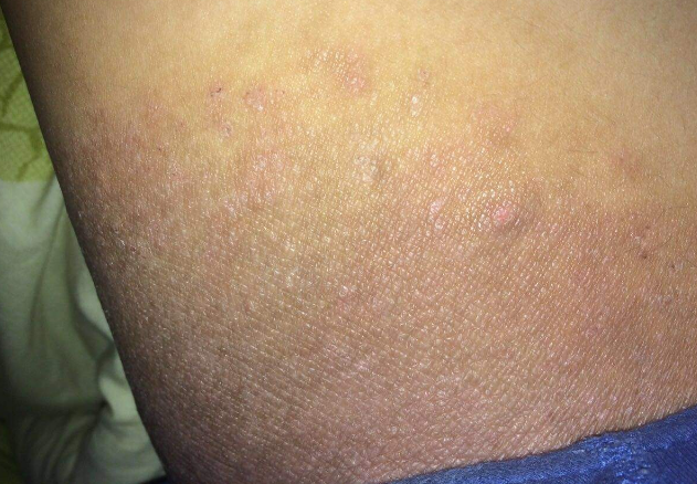 體股癬初期現象