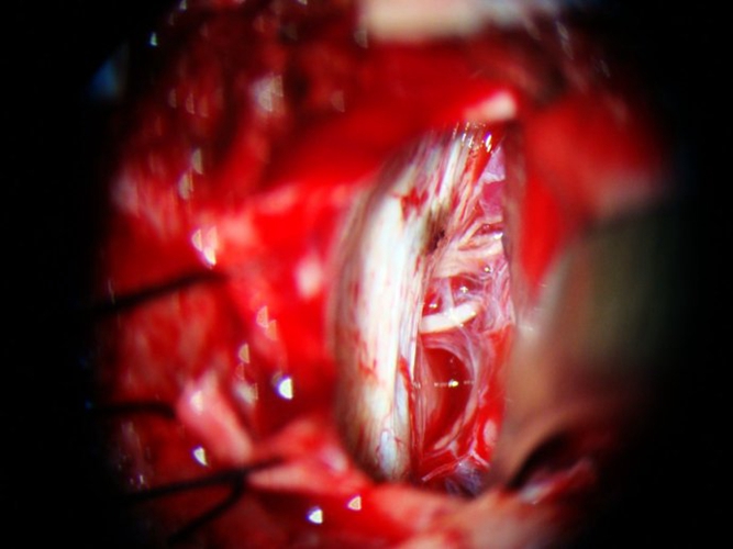 三叉神經微血管減壓手術