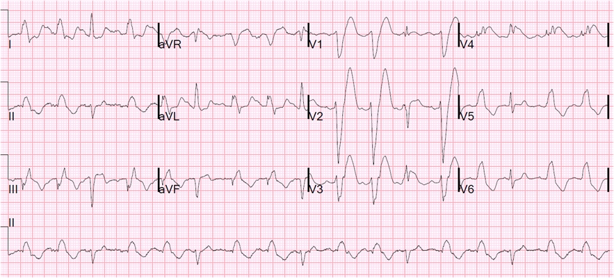 預激綜合徵心電圖 (86) 