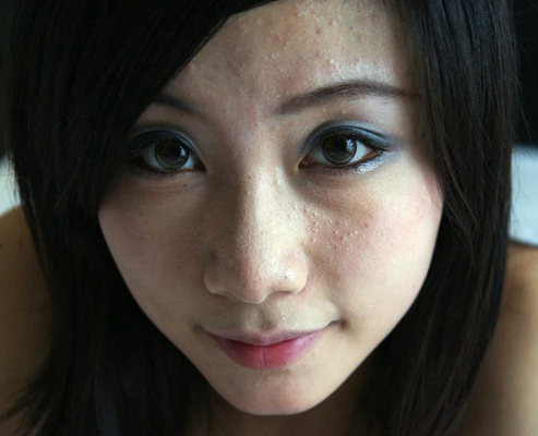 血熱的症狀痘痘