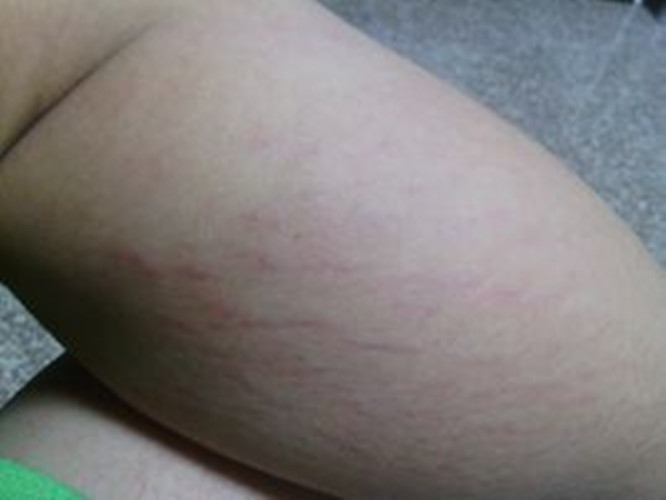 小腿上的放射性皮炎