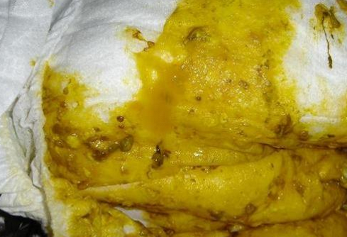 新生兒消化不良大便圖 (65) 