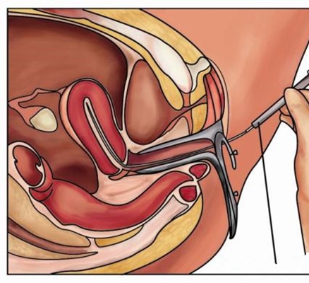 人工受完孕的過程 (44) 
