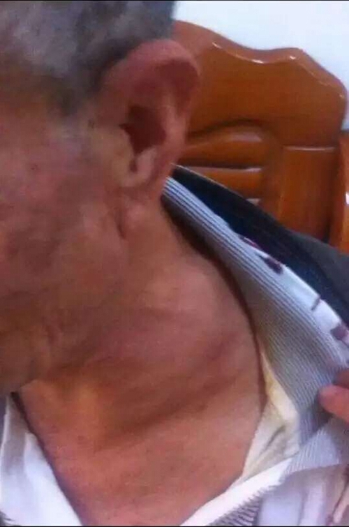 晚期肺腺癌患者左鎖骨轉移