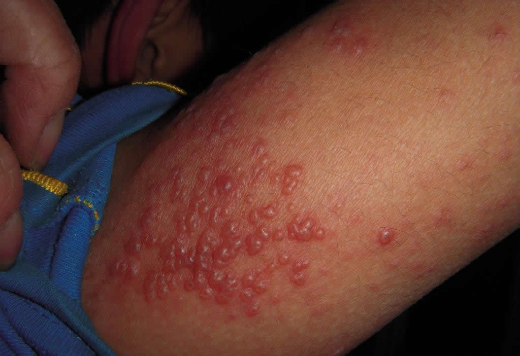 胳膊日光性皮炎