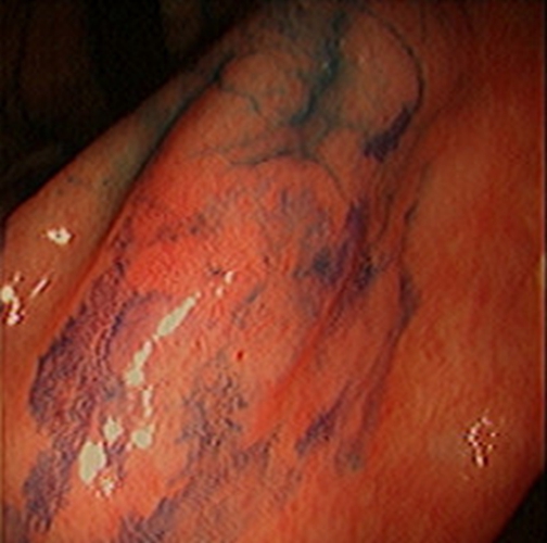 急性胃炎症狀的表現的