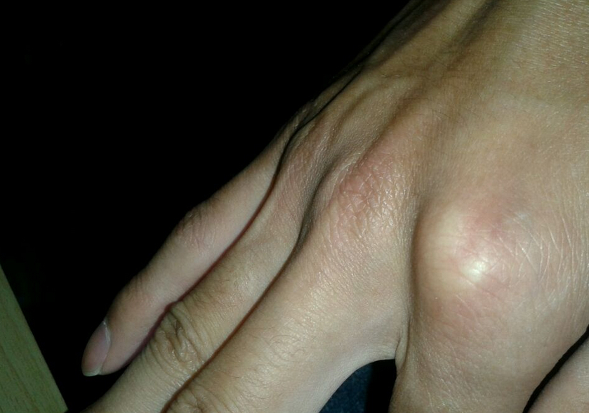 橈骨莖突狹窄性腱鞘炎的