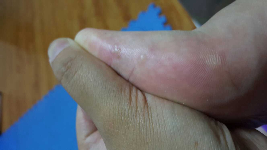 禽流感症狀表現圖 