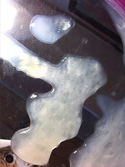 不正常精液液化