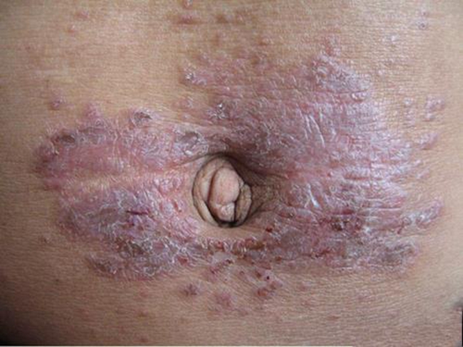 肚臍周圍接觸性皮炎