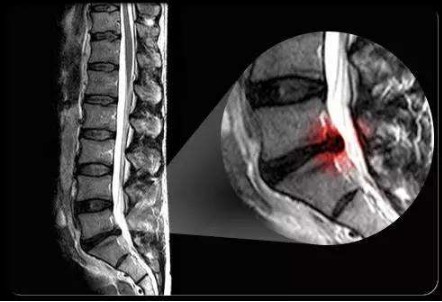 坐骨神經痛的症狀圖 (8) 