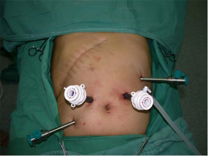 窺鏡手術治療腸粘連