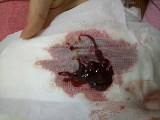 先兆流產分泌物