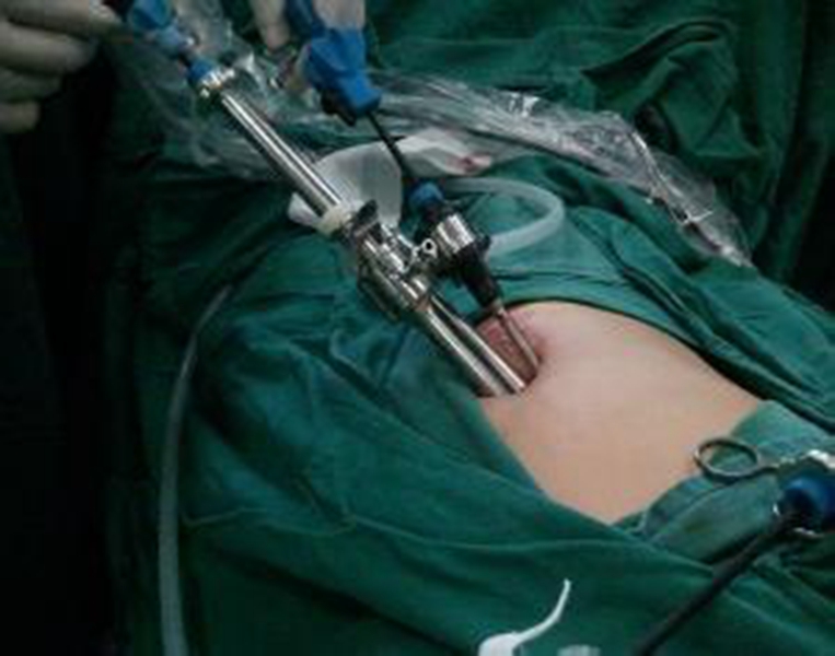 腎結石手術過程中