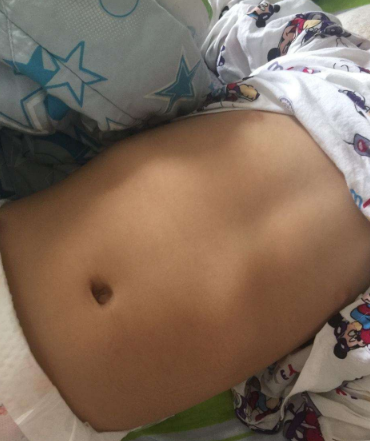 寶寶缺鈣雞胸圖 (51) 