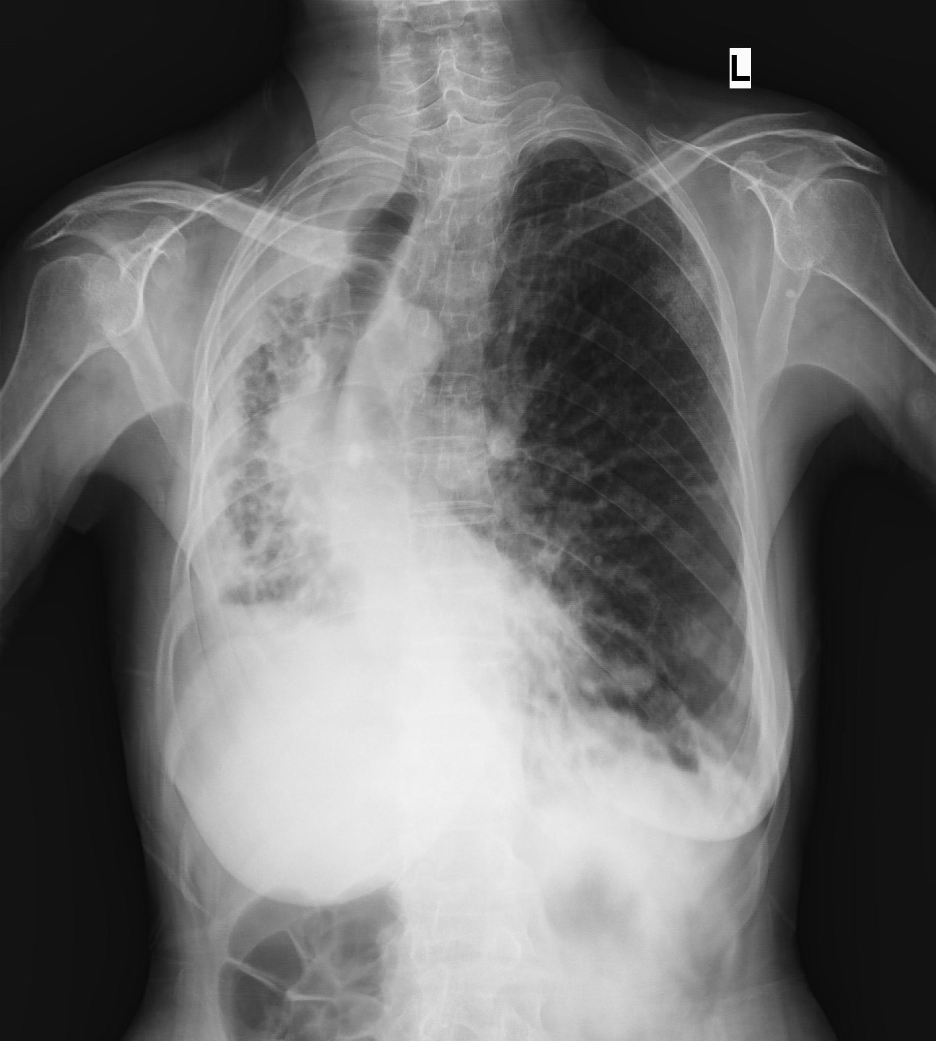 ＿右肺纖維化真實案例胸片