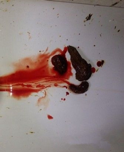 腸癌的症狀 (50) 