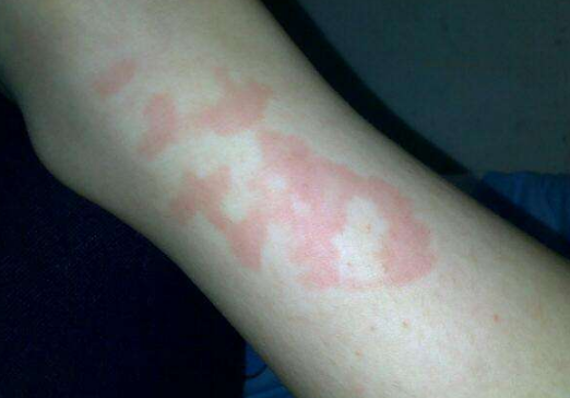 玫瑰糠疹母斑