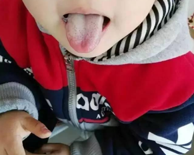 胃炎的症狀舌頭