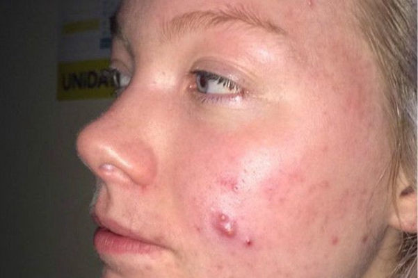 激素臉排毒症狀 (7) 