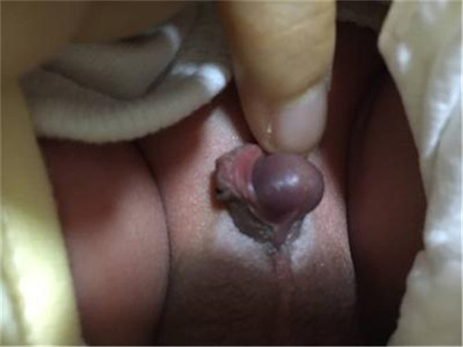 嬰兒患尿道下裂症狀