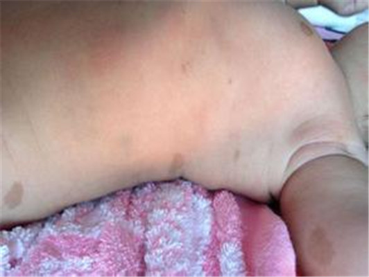 牛奶咖啡斑 (47) 