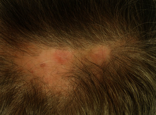 頭皮脂溢性皮炎 (8) 
