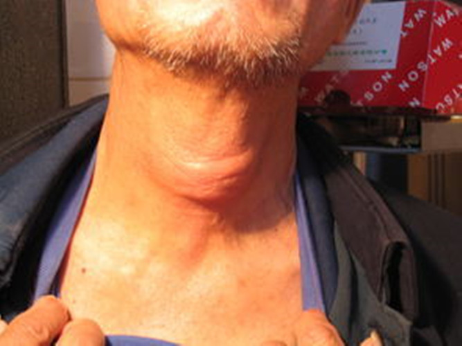 嚴重的喉腫瘤的