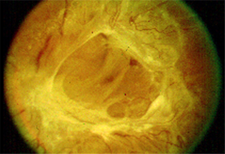 增生引起視網膜脫落