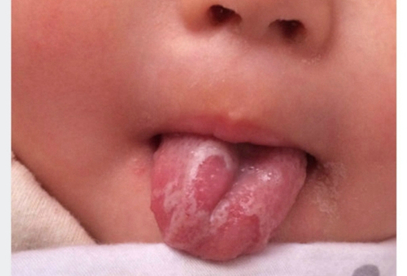 寶寶鵝口瘡 (69) 