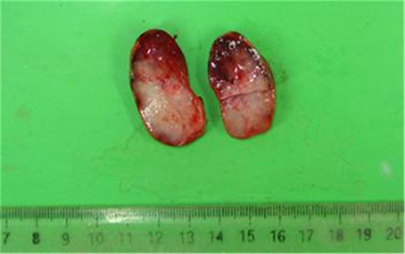 男性肉芽狀假性溼疣