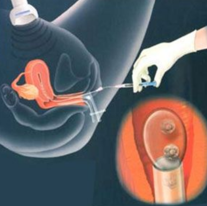 治療中的人工陰道