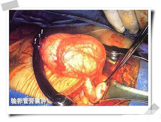 輸卵管巧克力囊腫
