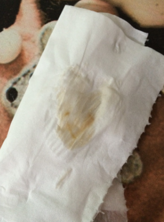 白帶帶有褐色分泌物 (60) 